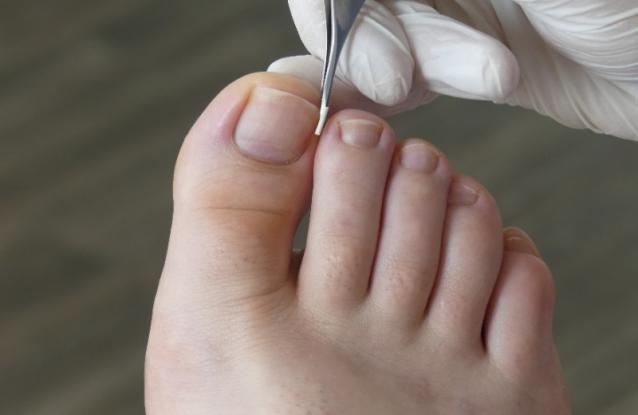 ongle incarné