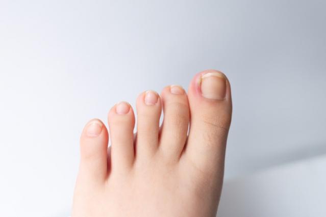 traitement ongles incarnés
