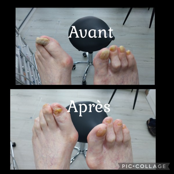 Avant / Après d'un soin de pédicure spécialisé au cabinet situé sur Heusy.