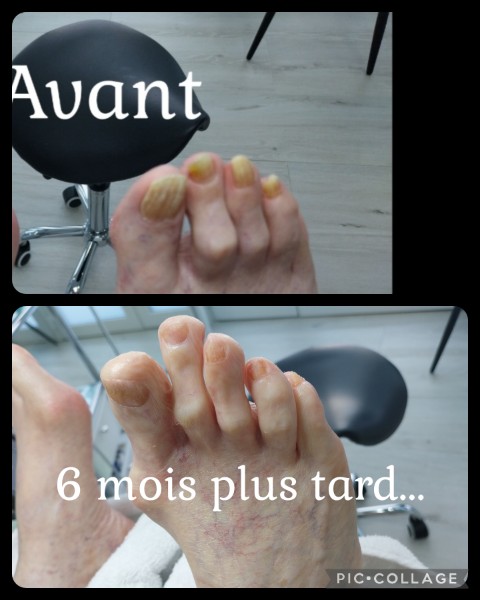 Avant / Après d'un soin de pédicure spécialisé au cabinet situé sur Heusy.