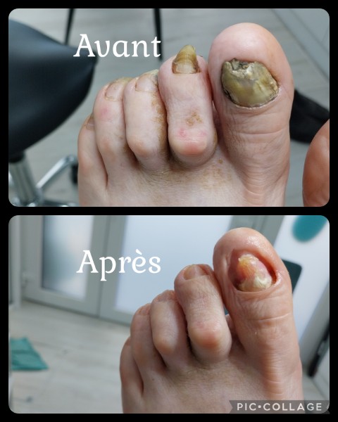 Avant / Après d'un soin de pédicure spécialisé au cabinet situé sur Heusy.