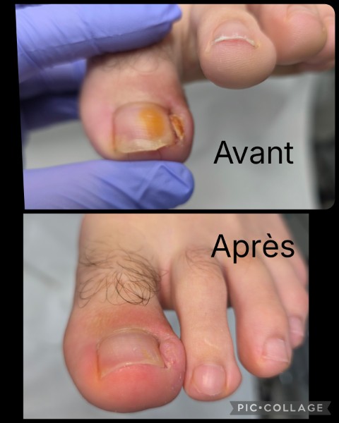 Avant / Après d'un soin de pédicure spécialisé au cabinet situé sur Heusy.