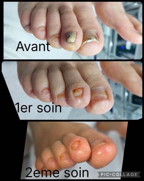 Avant / Après d'un soin de pédicure spécialisé au cabinet situé sur Heusy.
