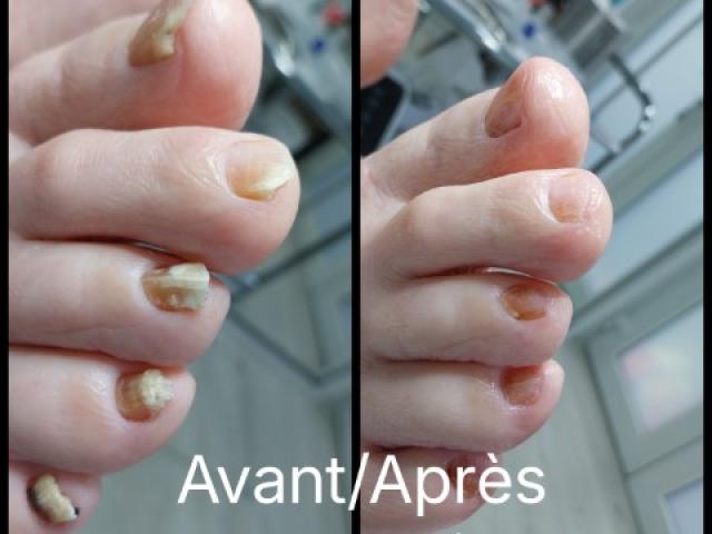 Est-ce qu’un soin de pédicure spécialisée peut faire la différence ?