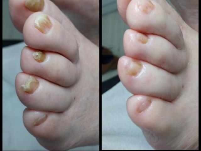 Est-ce qu’un soin de pédicure spécialisée peut faire la différence ?