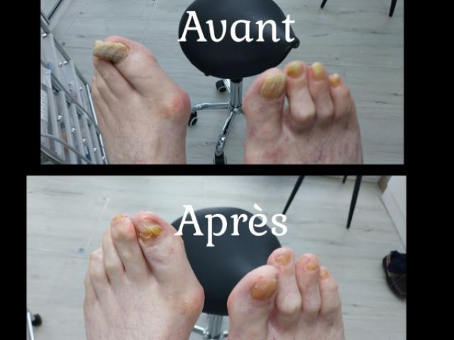 Avant / Après d'un soin de pédicure spécialisé au cabinet situé sur Heusy.