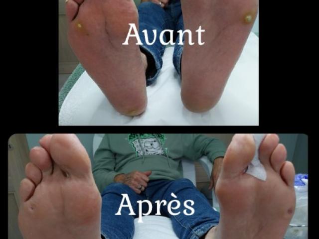 Avant / Après d'un soin de pédicure spécialisé au cabinet situé sur Heusy.