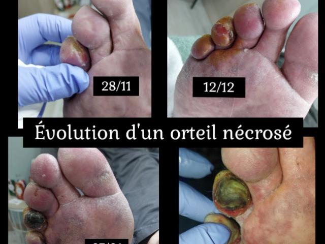 Comment prendre soin de ses pieds en étant diabétique? Voici quelques conseils!