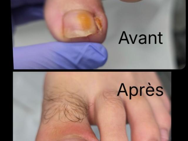 Avant / Après d'un soin de pédicure spécialisé au cabinet situé sur Heusy.