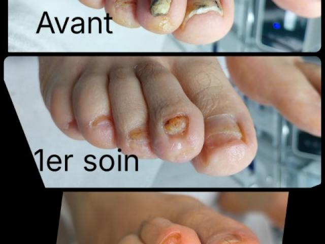 Avant / Après d'un soin de pédicure spécialisé au cabinet situé sur Heusy.