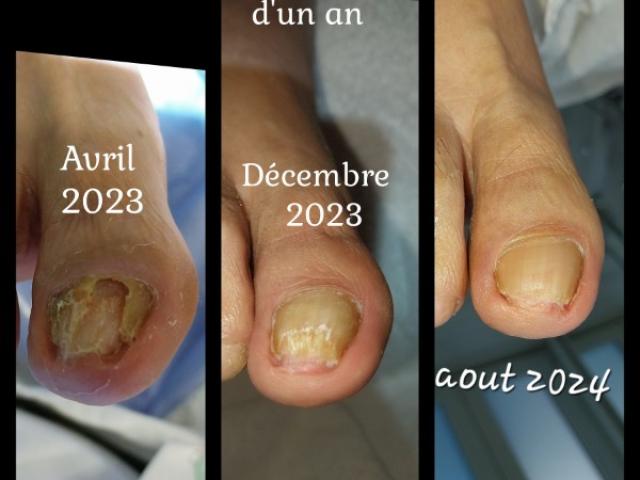 Comment traiter une mycose sur un ongle de pied de façon durable ?