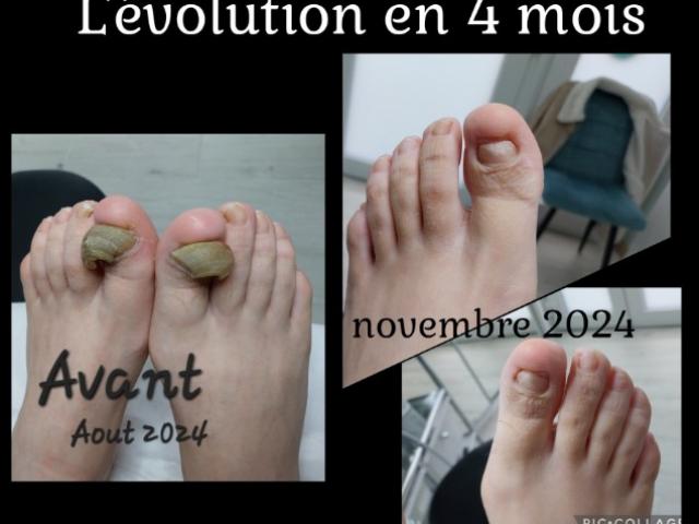 Comment traiter une mycose sur un ongle de pied de façon durable ?