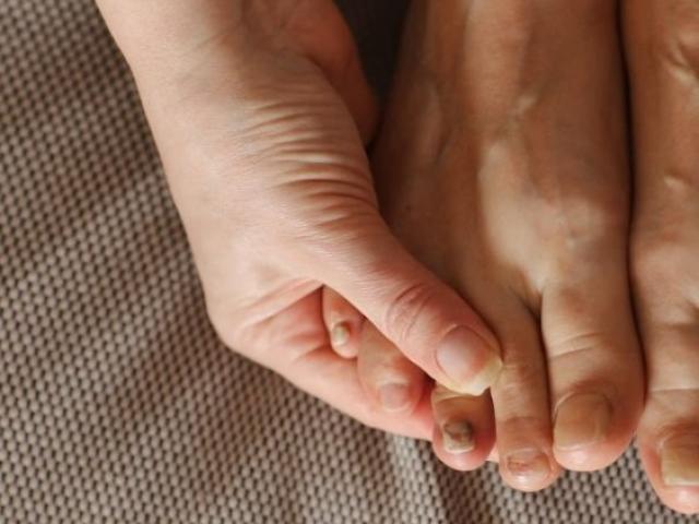 Faire soigner ses pieds sous chimiothérapie par une pédicure médicale.